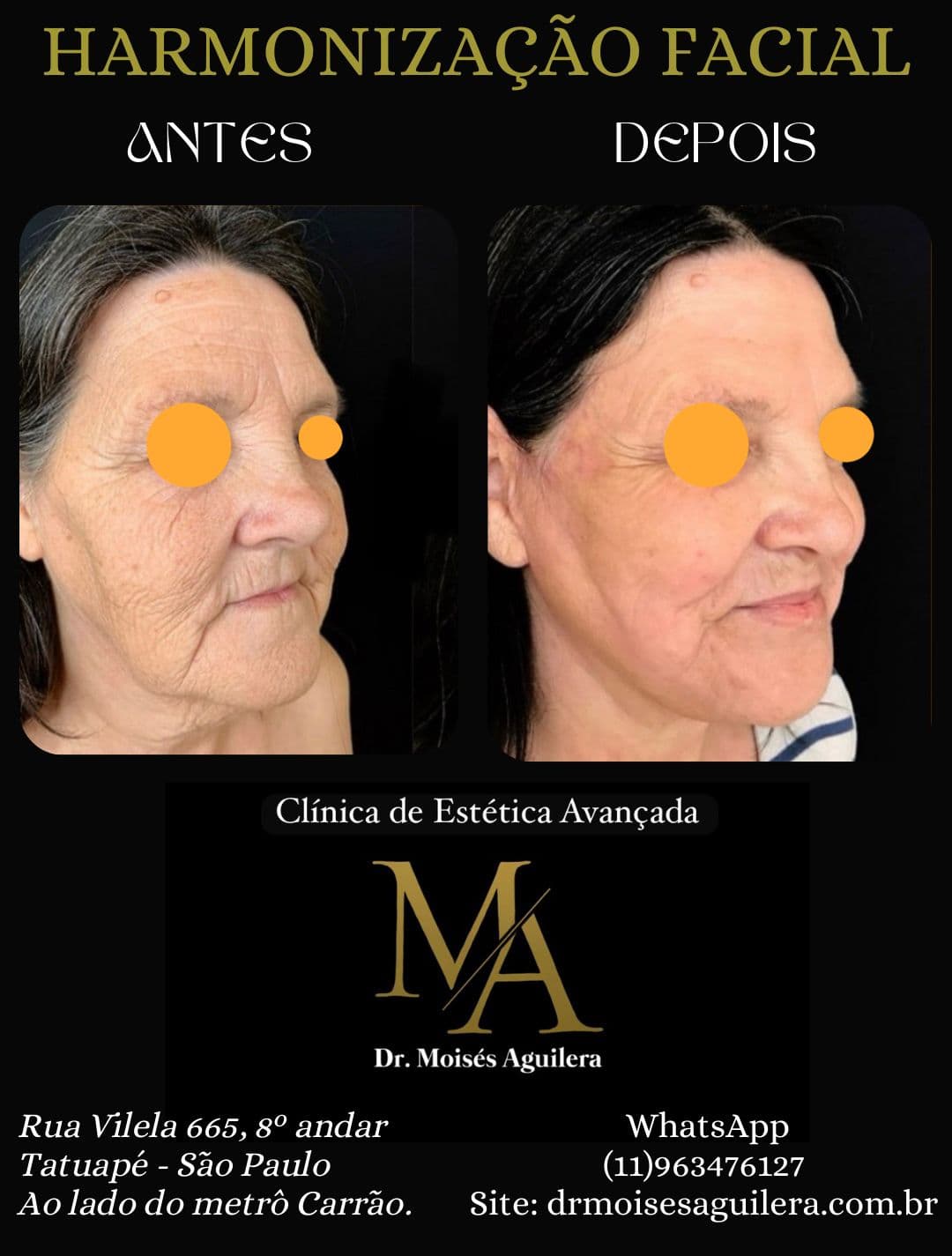 Antes e depois — Harmonização Facial