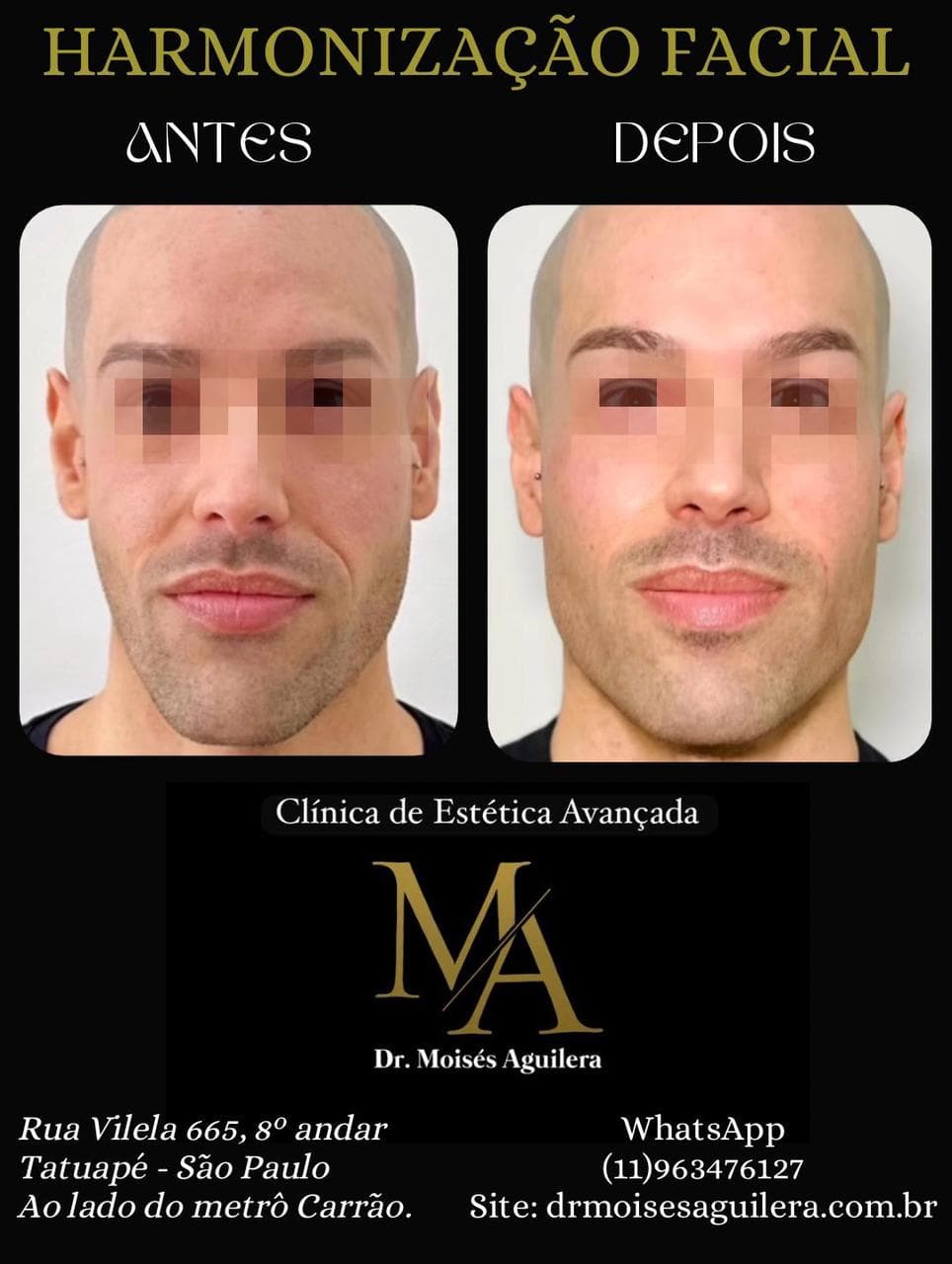 Antes e depois — Harmonização Facial