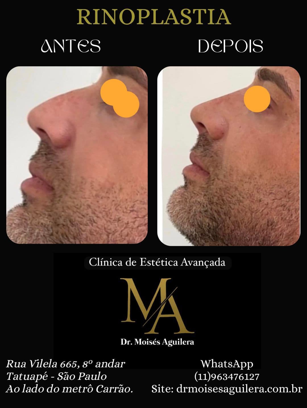 Antes e depois — Harmonização Facial