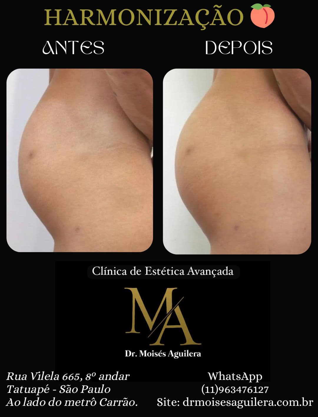 Antes e depois — Glúteo