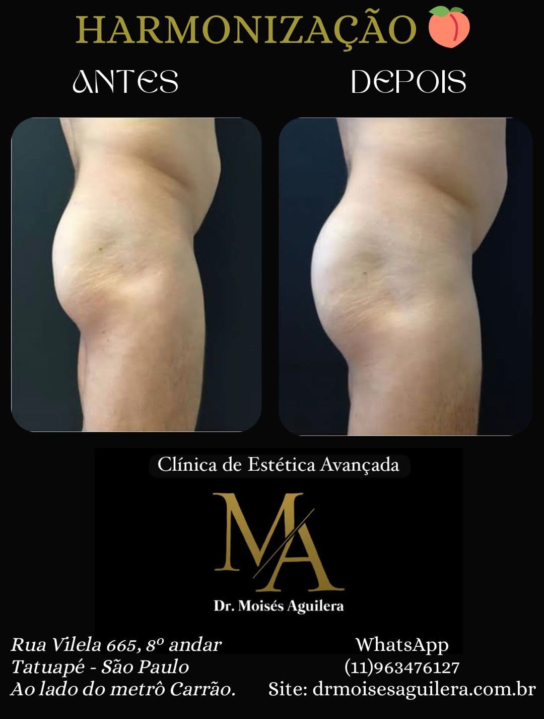 Antes e depois — Glúteo