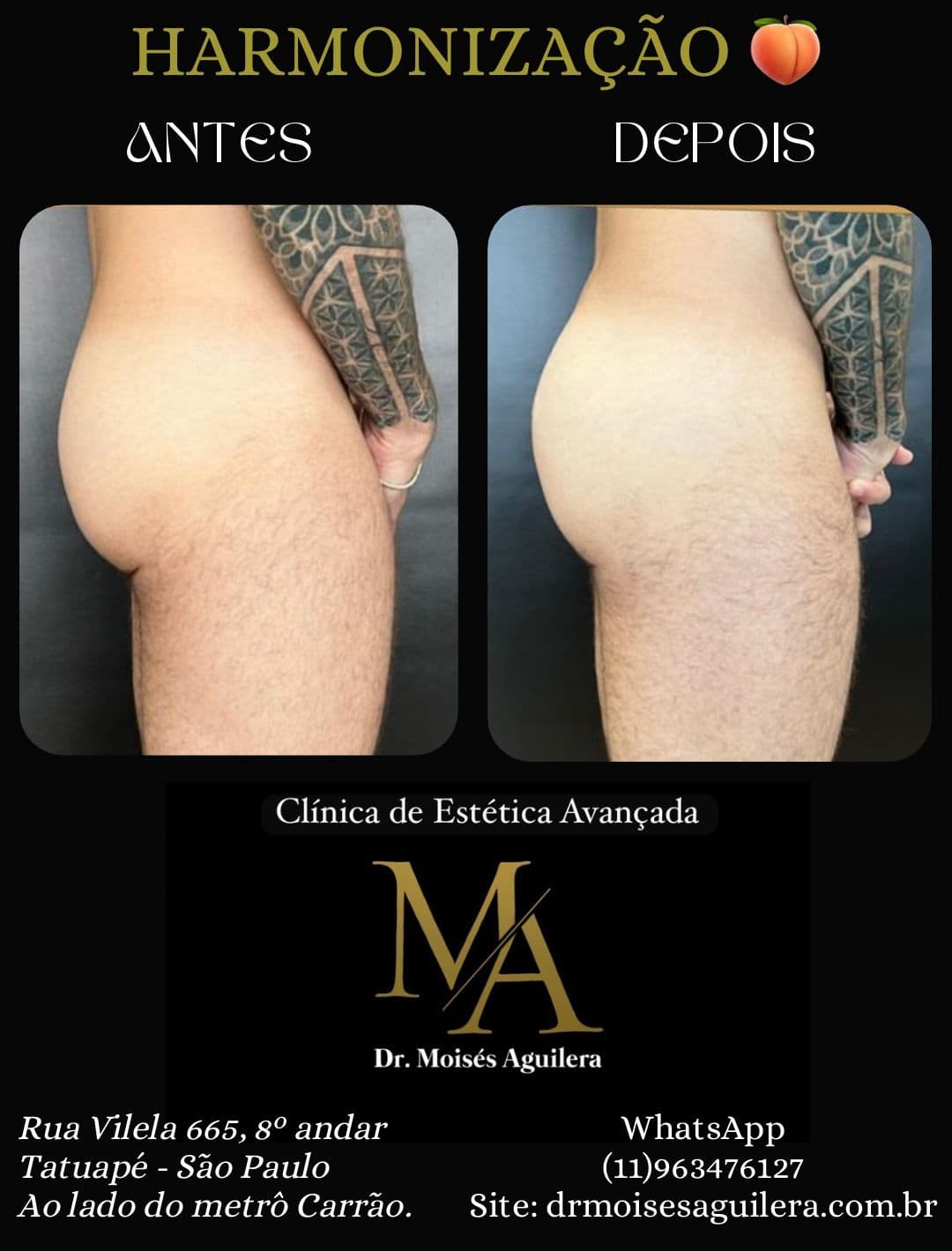 Antes e depois — Glúteo