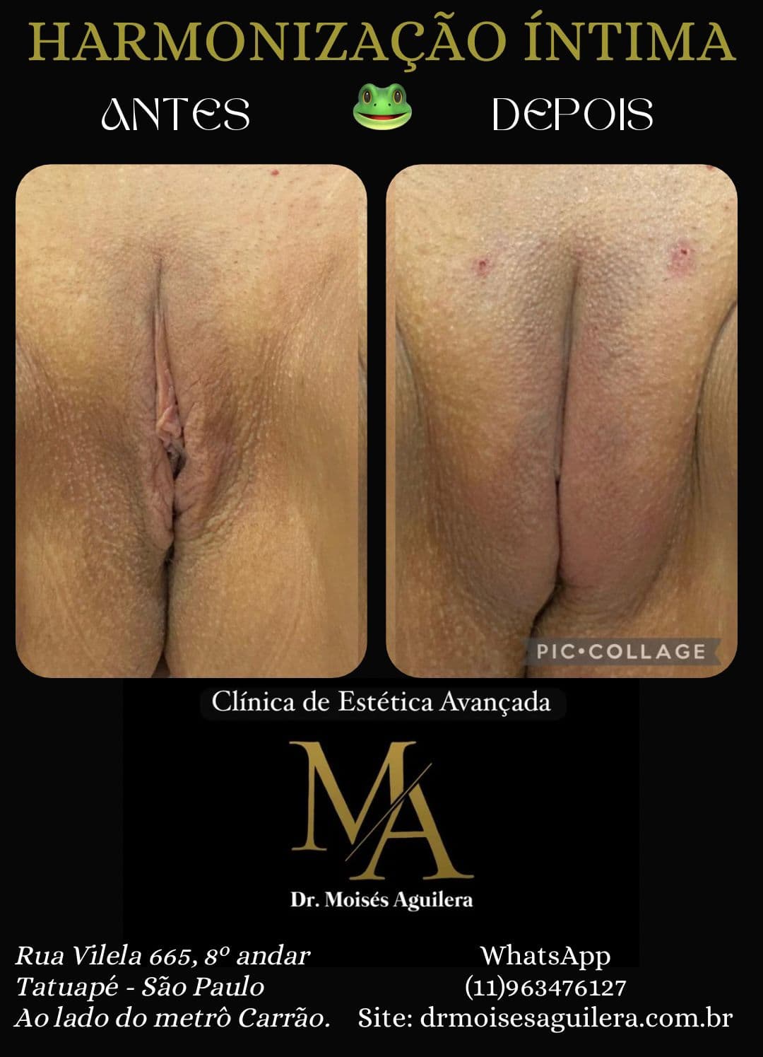 Antes e depois — Harmonização Íntima