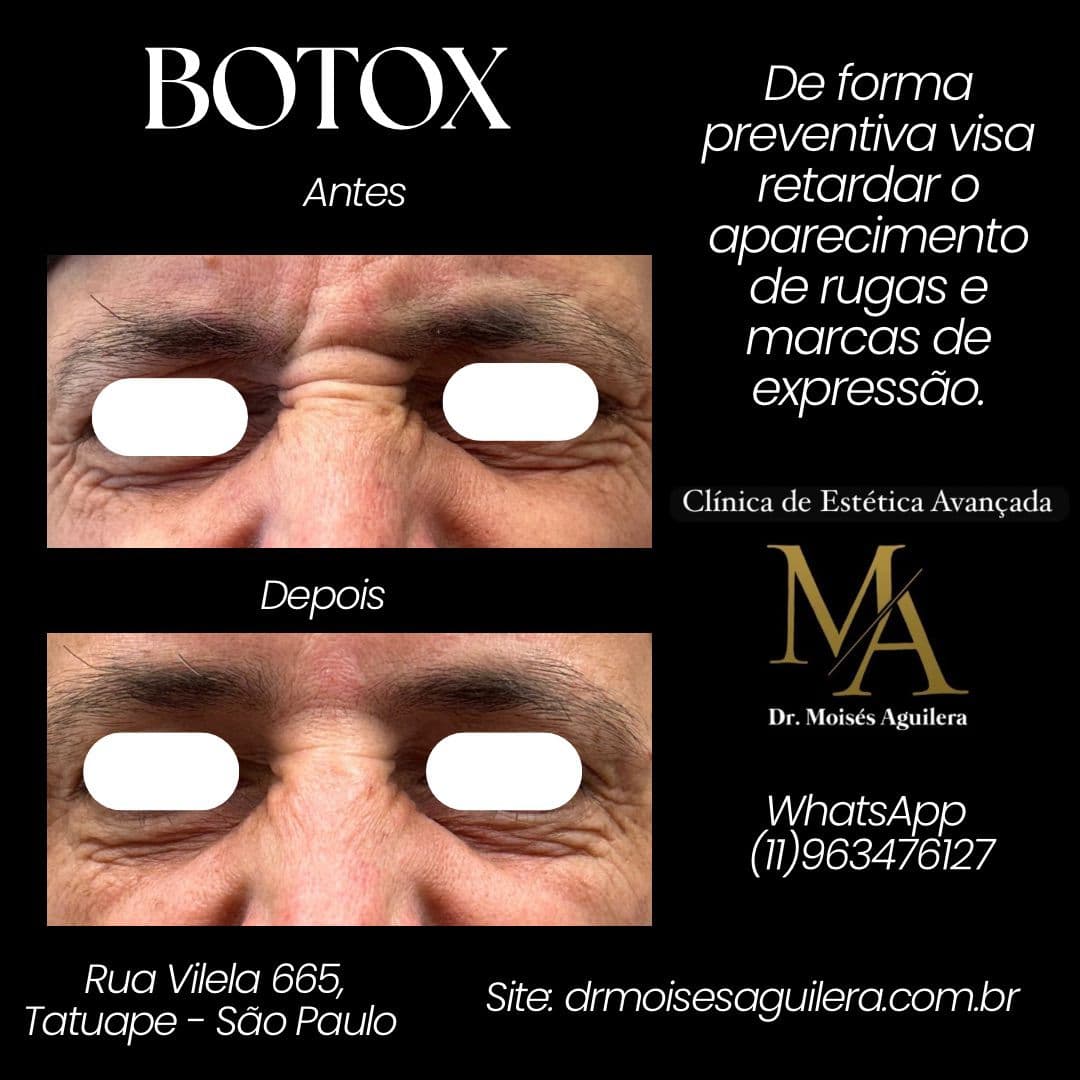Antes e depois — Botox